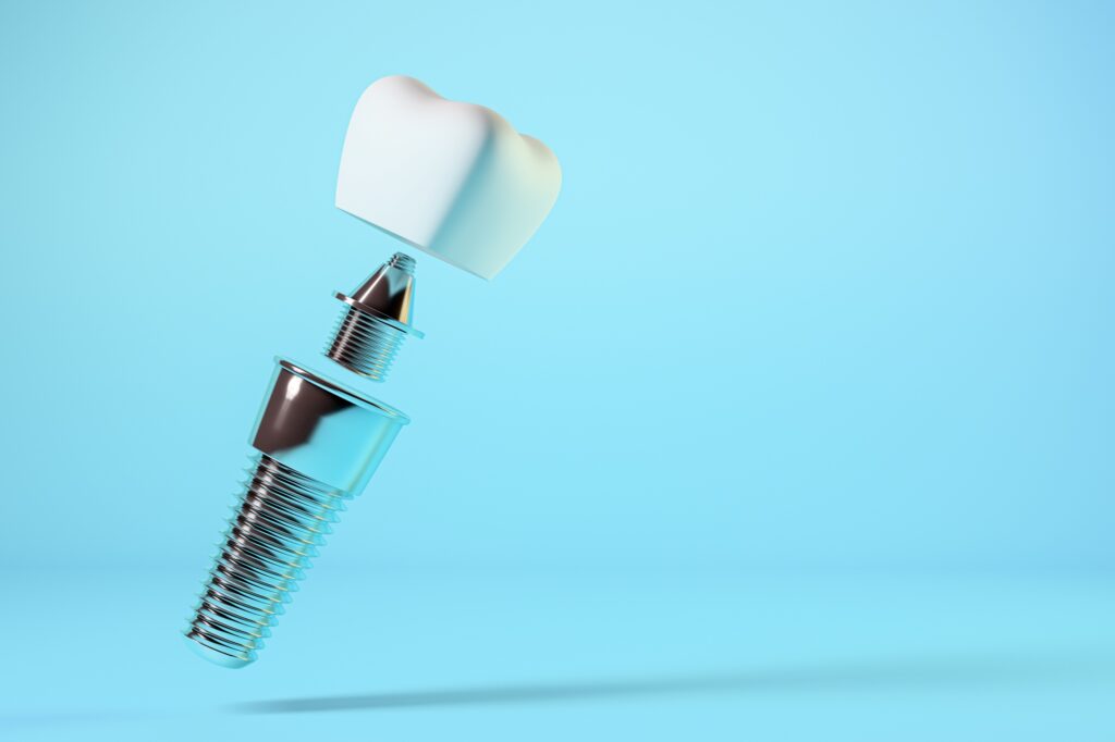 Dental Implants Arden NC Dental Implants