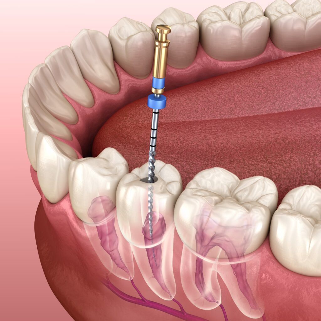 Root Canals Root Canals Arden North Carolina