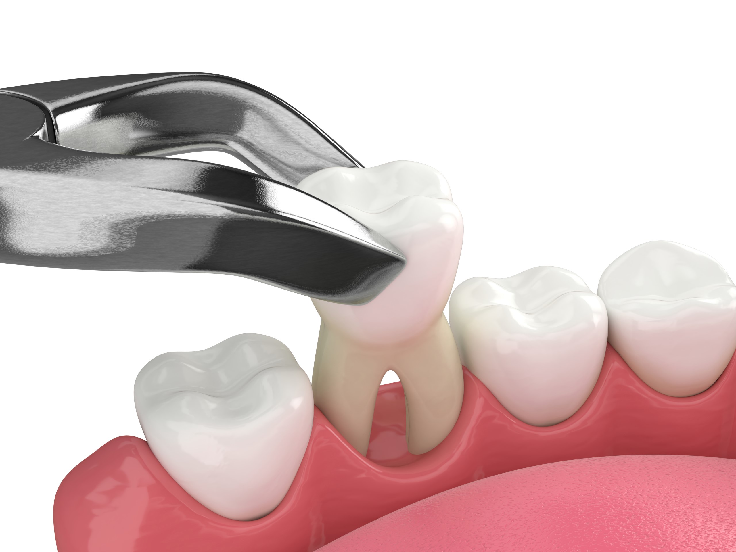 Tooth Extractions Arden NC