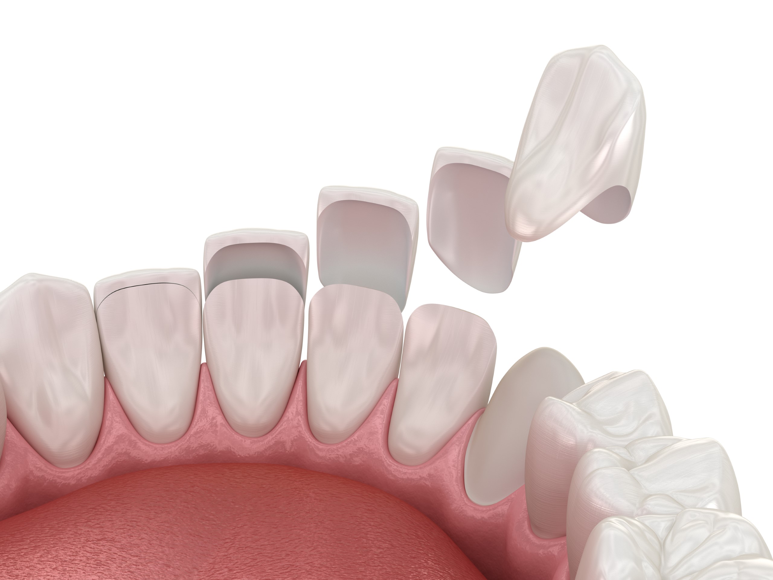 Veneers Arden NC Dentist