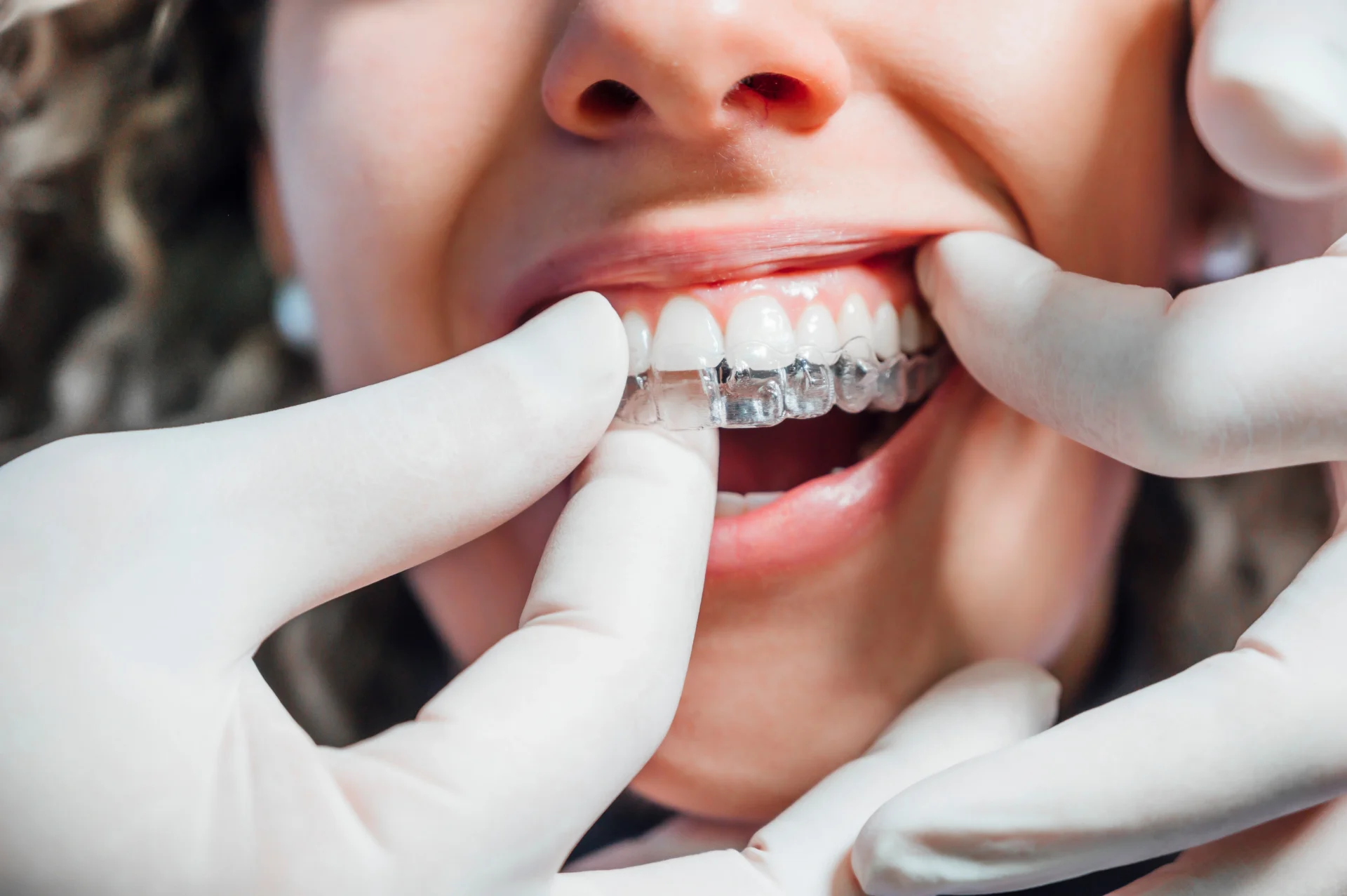 Why Arden Adults are Choosing Clear Aligners Over Traditional Braces Clear Aligners - Arden, NC